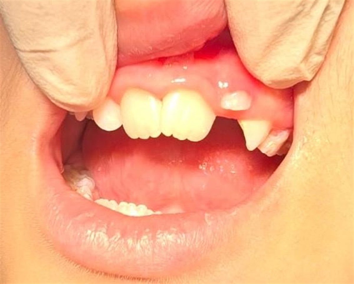 Patient smile result